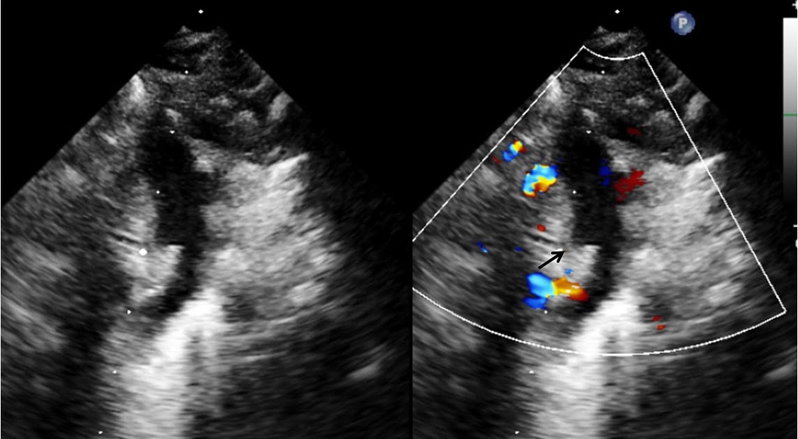 Pedi cardiology: Echo: What is shown by black arrow?