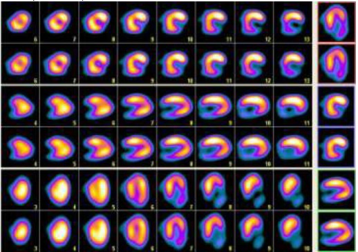 Dr Yasar Ile Sagliga Dair Kalp Sintigrafisi Myokard Perfuzyon Sintigrafisi