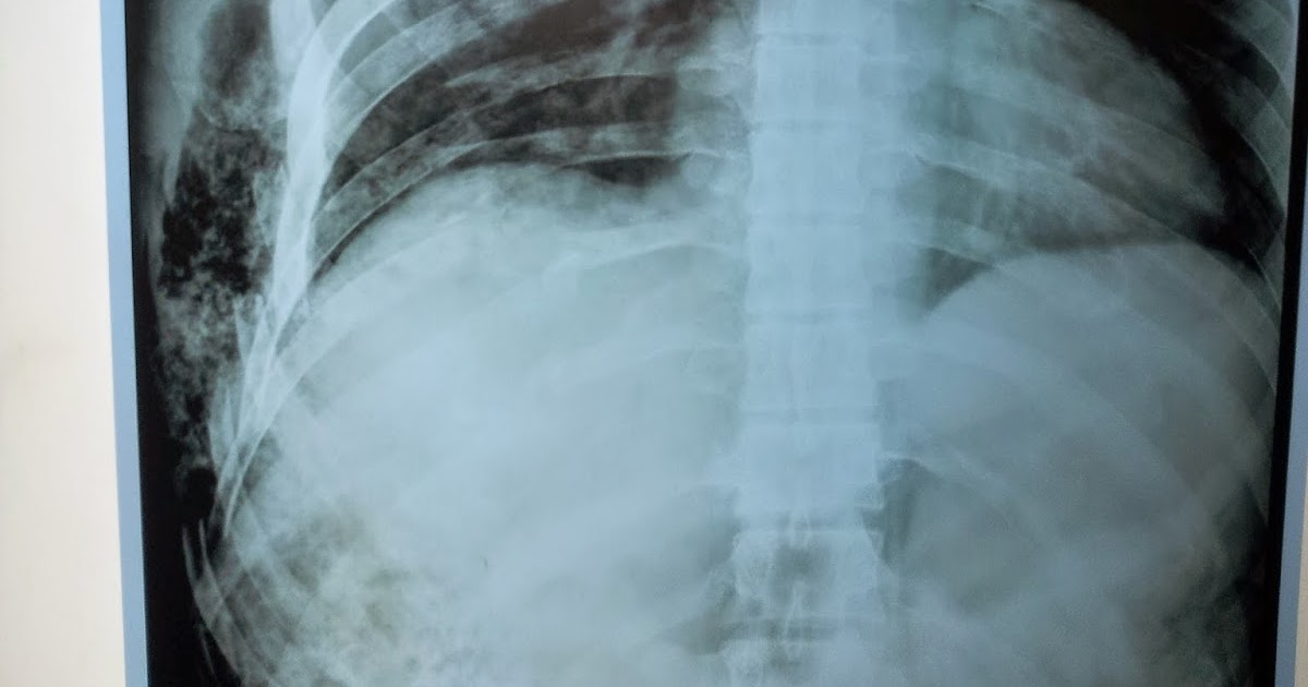 General Surgery Clinics A Surgeon's Blog Surgical Emphysema