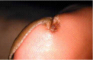 Eggshell Nail Disorder