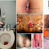 Obat Wasir (Hemoroid) Parah Manjur Terdaftar BPOM thumbnail