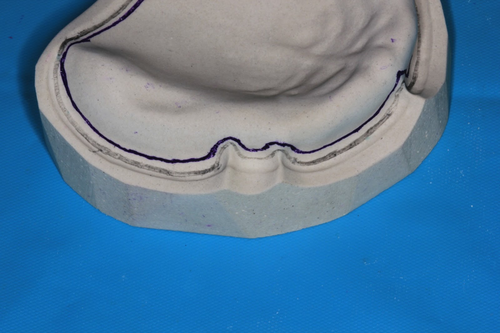 Step by step Guide for Understanding the Prosthodontics Spacer for