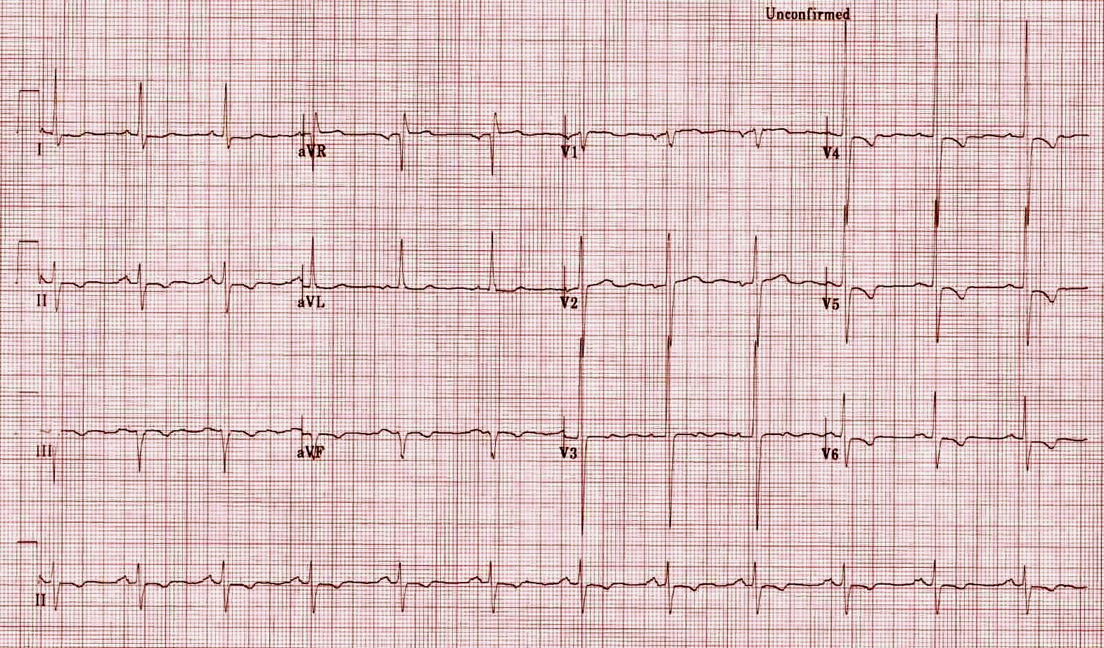 Biventricular Hyperthrophy INA ECG