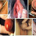 Turuk Kencing Sakit Keluar Nanah thumbnail