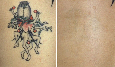 Tattoos Can Be Troublesome to Remove