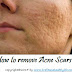 How to remove Acne Scars