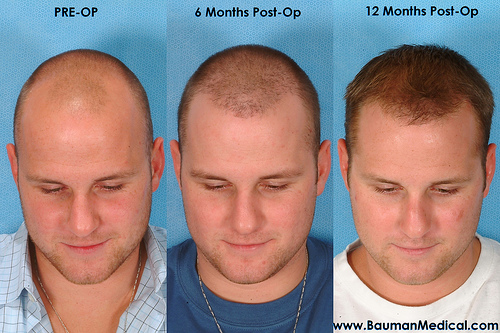Hair transplant, Hair Transplantation - Men's Health - Health and.