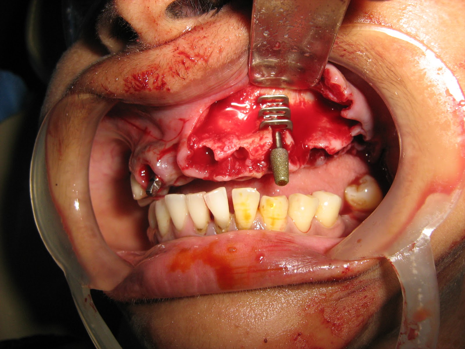 Dental Implants From Malaysia & Singapore: Basal implants vs Zygomatic