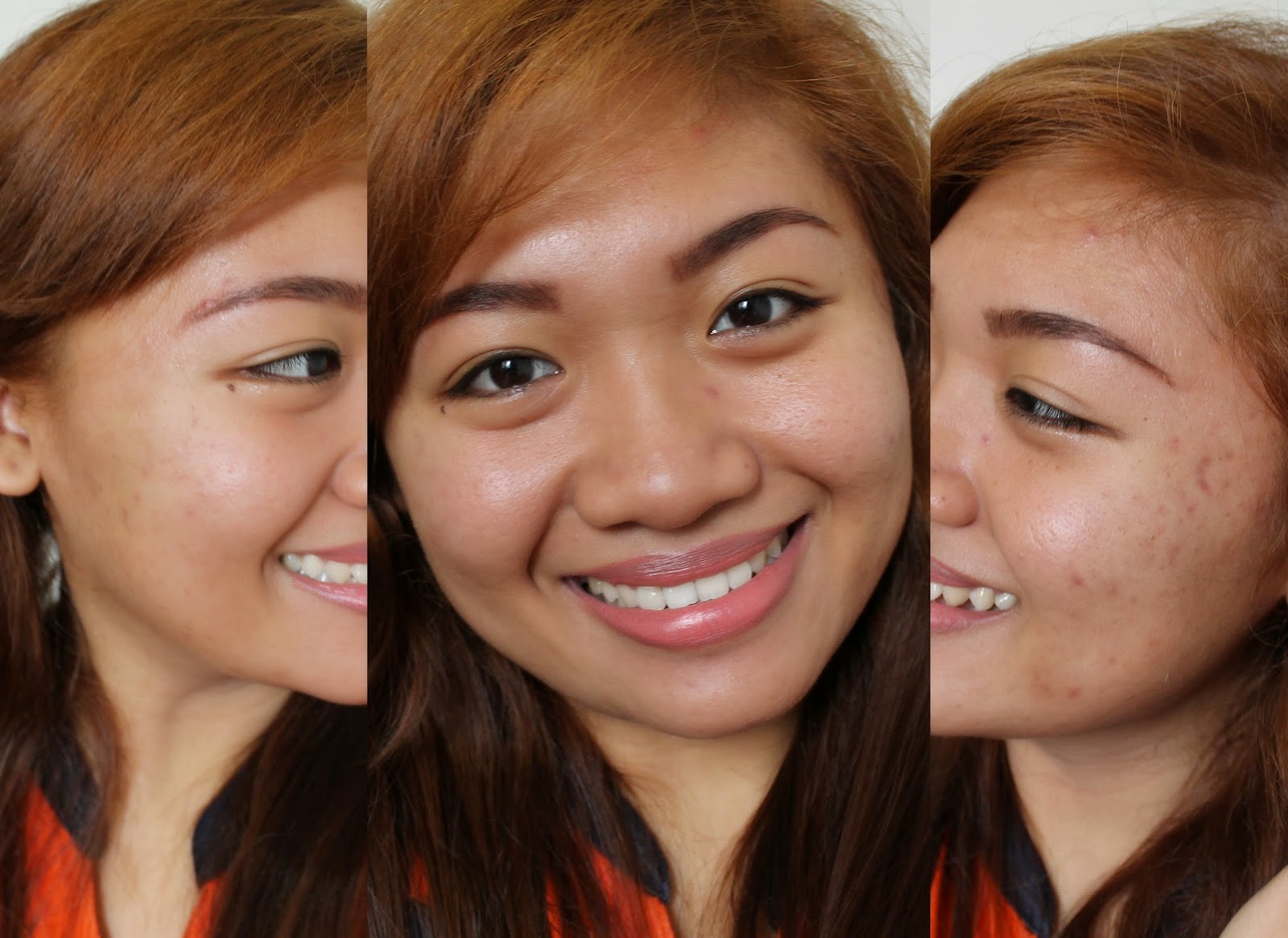 SKINMATE SHARK OIL REVIEW (How I Cleared My Acne)