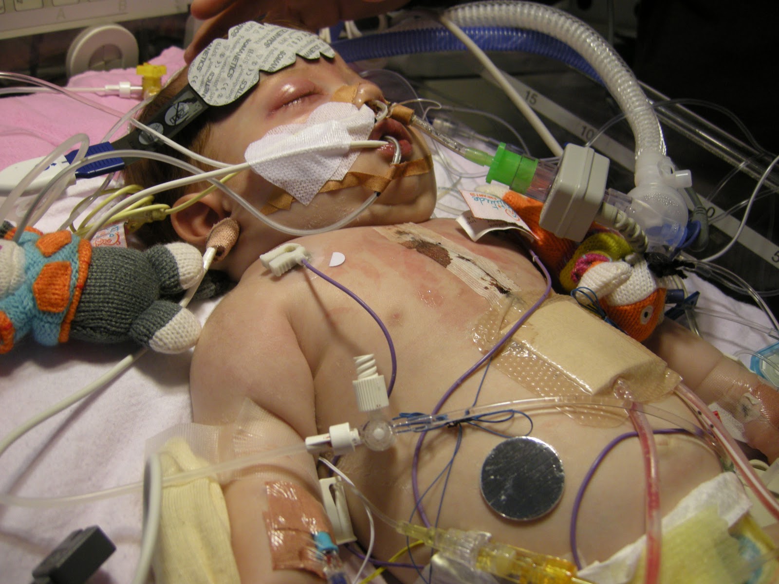 Junctional Ectopic Tachycardia