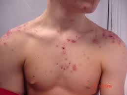 Chest Acne
