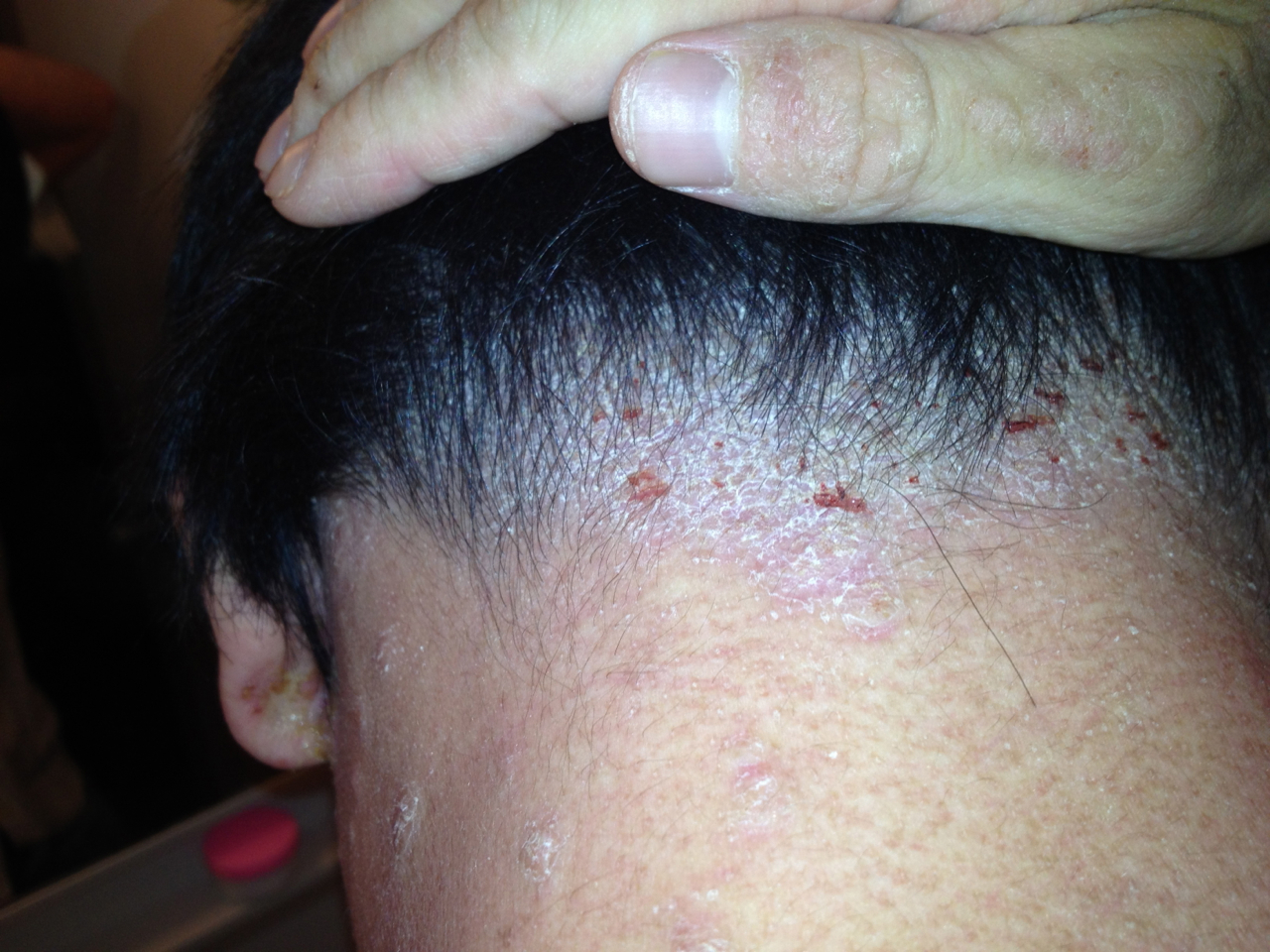 アトピー写真ブログ 首と後頭部