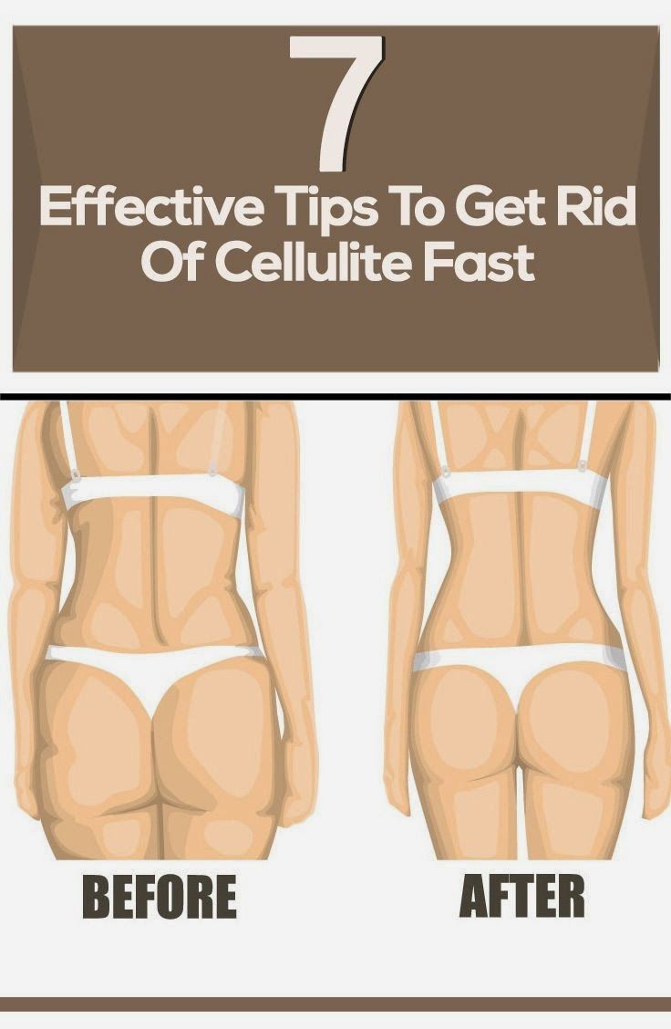 7 Effective Tips to Get Rid of Cellulite Fast Skinny MoMs