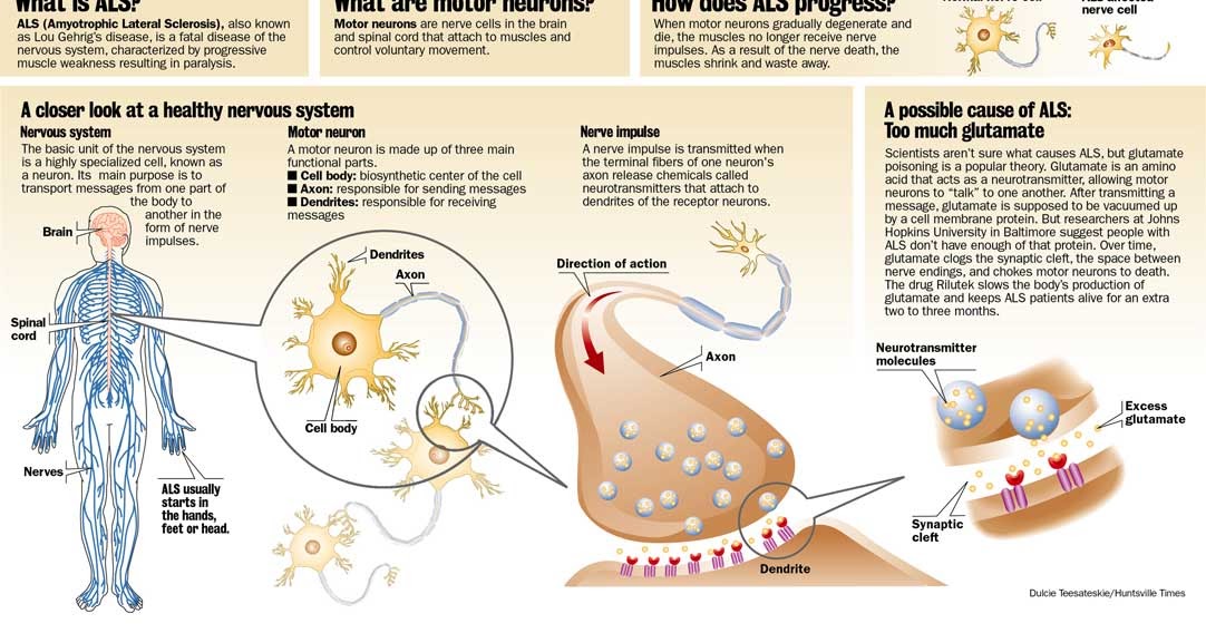 a study on amyotrophic lateral sclerosis or als Start studying amyotrophic lateral sclerosis (als) learn vocabulary, terms, and more with flashcards, games, and other study tools. a study on amyotrophic lateral sclerosis or als Start studying amyotrophic lateral sclerosis (als) learn vocabulary, terms, and more with flashcards, games, and other study tools.