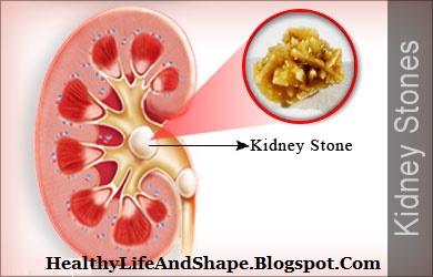 Natural Herbs To Dissolve Kidney Stones Natural Herbs To Dissolve Kidney Stones