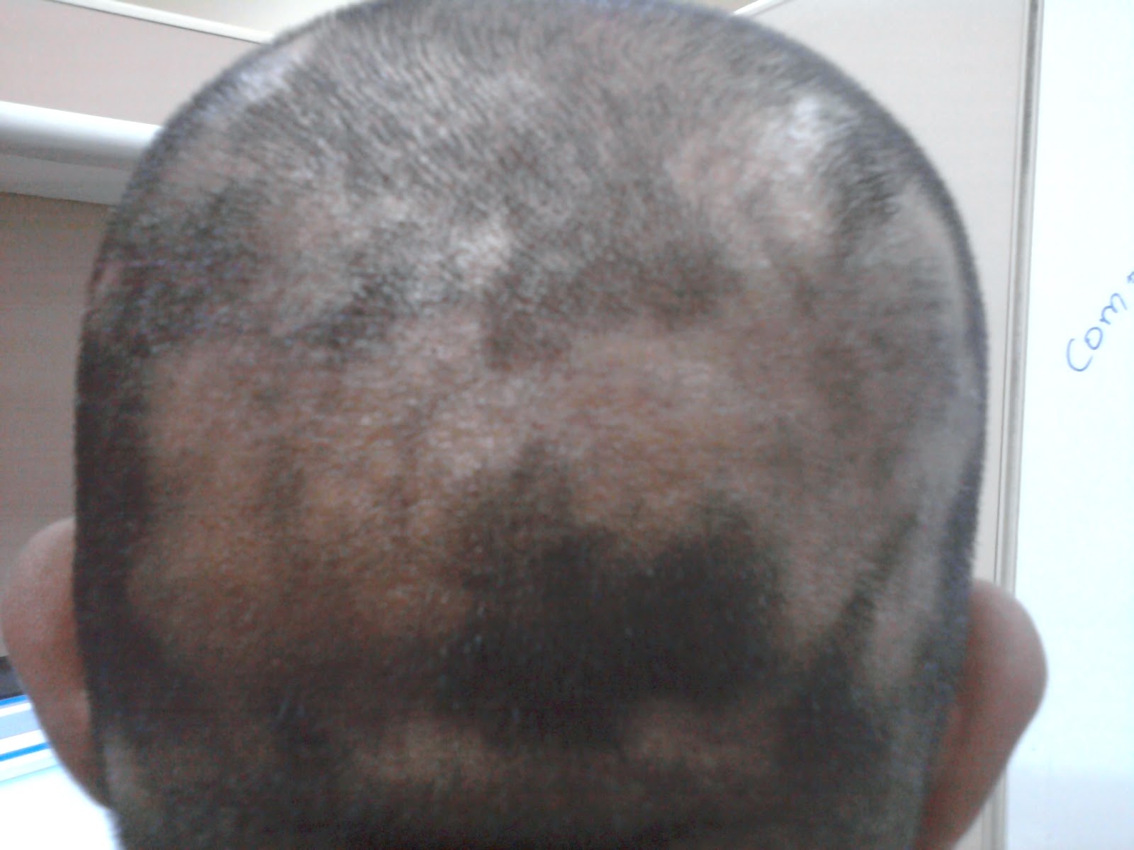 Alopecia areata: Alopecia areata success story