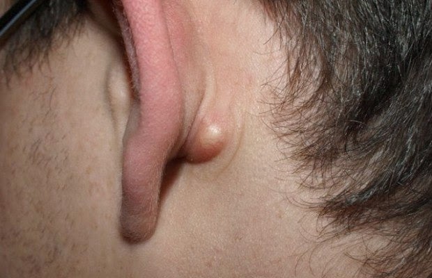 topical-iodine-for-cysts