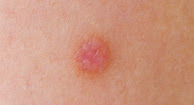 Picture of Warts