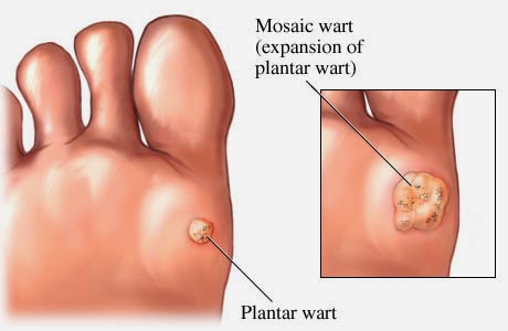 nasir tedavisi nasir nasil gecer