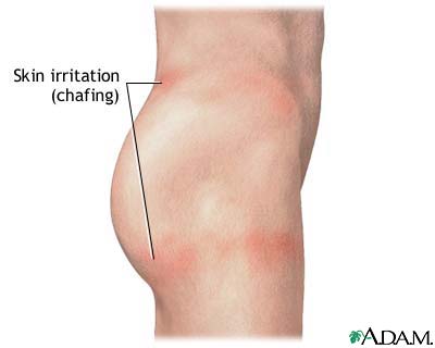 chafing legs
