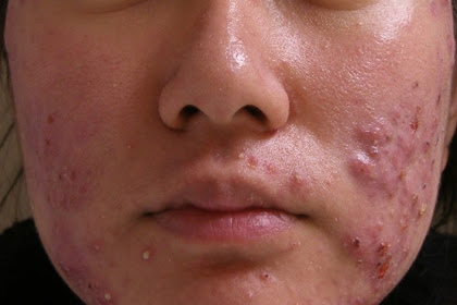 Health Secrets: Tretinoin cream best acne cream for acne