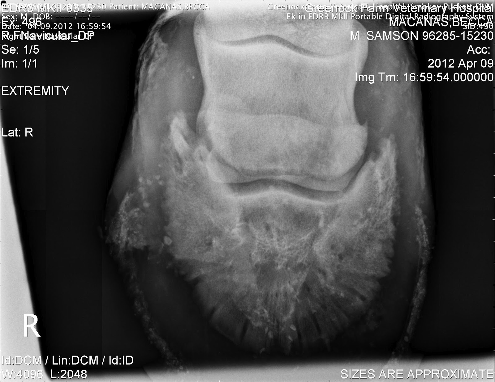 Riding Through the Fear Adventures in Congenital Bipartite Navicular Syndrome