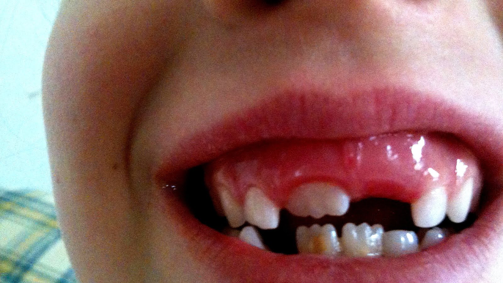 white spots on yellow teeth
