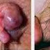 Gejala Wasir Bengkak thumbnail