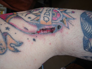 Infected Tattoo Care