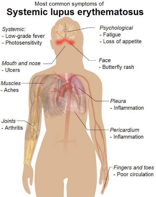 http://candidarticle.blogspot.com/2015/08/autoimmune-disease.html#