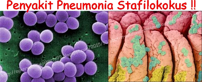 Obat Tradisional Pneumonia Stafilokokus