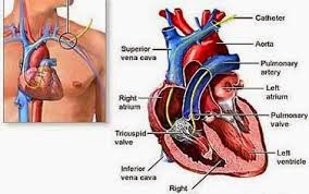 ضيق الصمام الميترالي امراض القلب والاعشاب