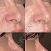 Rhinoplastie et produits de comblement ( fillers )