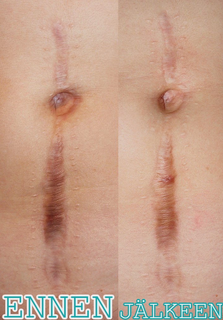 Testissa Bepanthen Anti Scar Arpigeeli