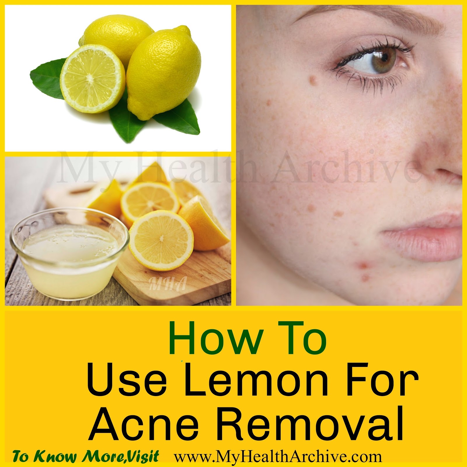 Minocycline For Acne Long Term Use