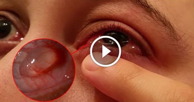 Watch - Skin Crawling Moment Man Pops Blister On His Own Eyeball