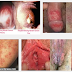 Obat Sipilis Laten Herbal Ampuh