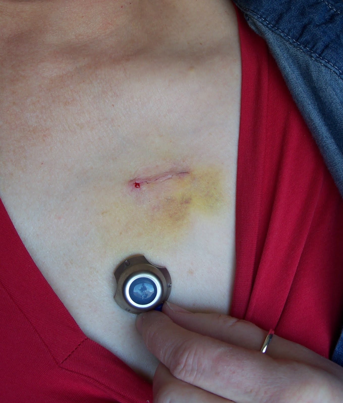 List 95+ Pictures Pictures Of Dissolvable Stitches In Mouth Excellent