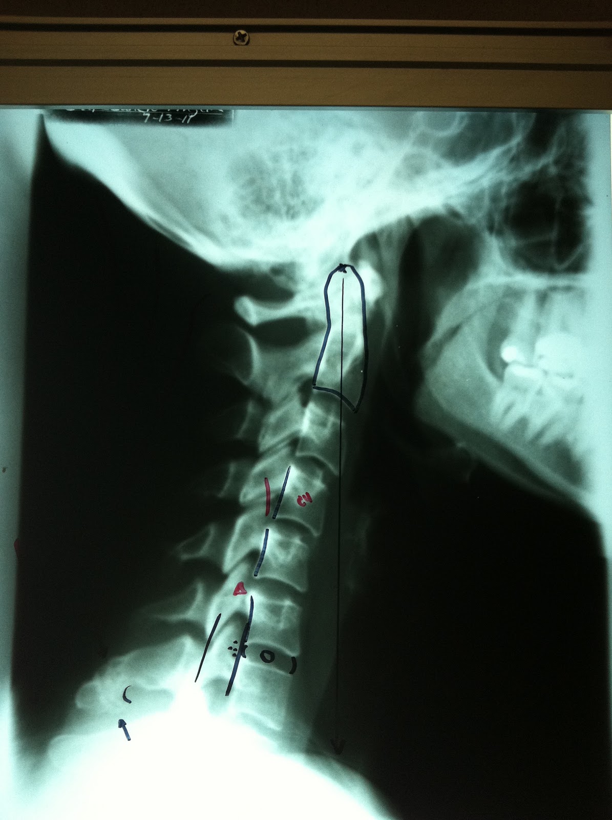 You're a Hoot! Broken Neck