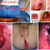Keluar Lendir dari Dalam Anus Saat Duduk, Kenapa Dok thumbnail