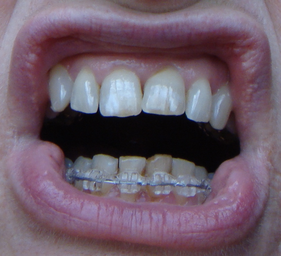 Braces at 56 Top Spring Removed and Thicker Wire on Lower Inspire Ice