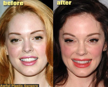 Plastic Surgery Prices on Plastic Surgery Price Pictures