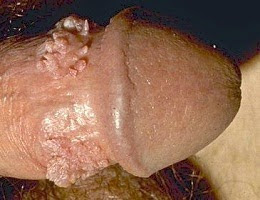 Merek Obat Kutil Kelamin Alami Merek Obat Kutil Kelamin Alami
