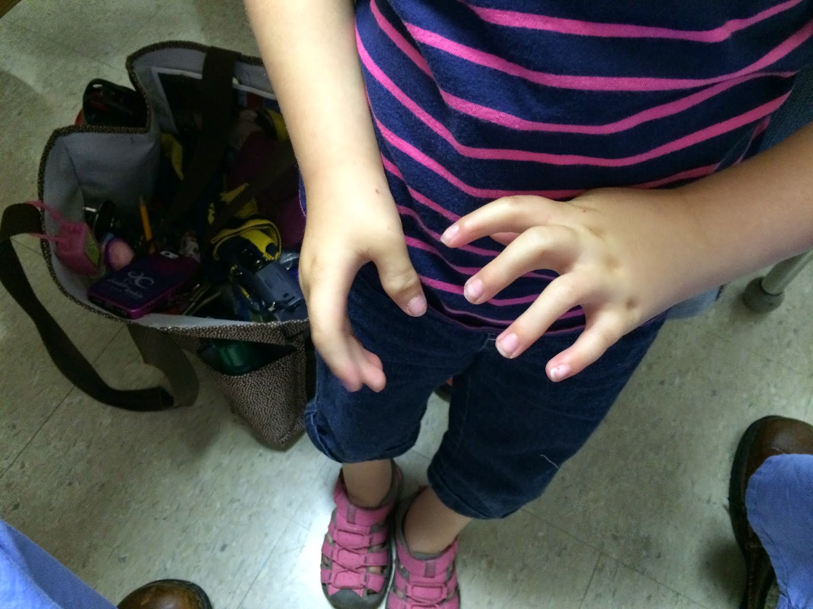 Diagnosing Distal Arthrogryposis Congenital Hand and Arm Differences