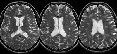 29+ Multiple Sclerosis Healthy Normal Brain Mri Images