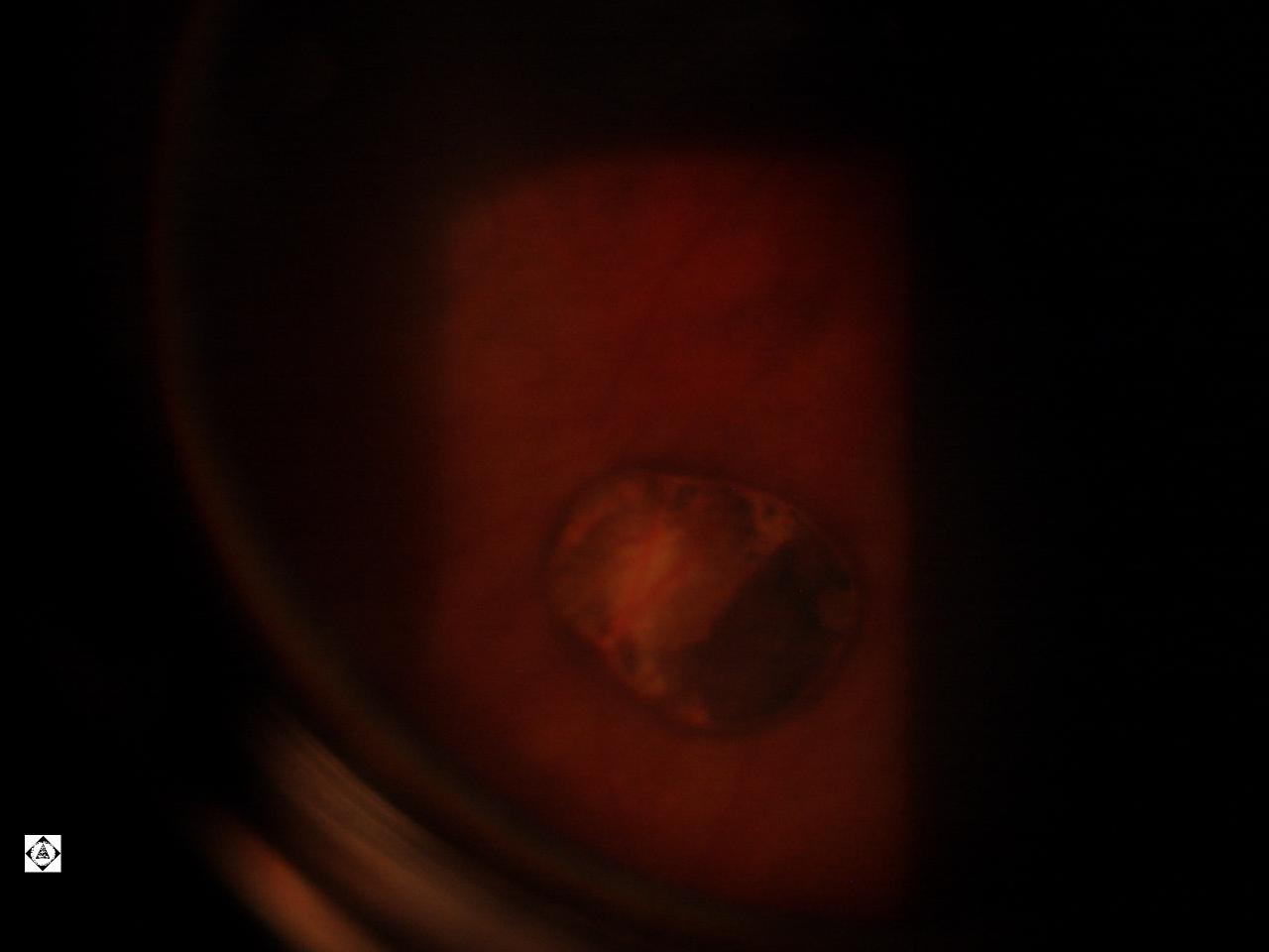 Sonoran Desert Eye Center CHRPE