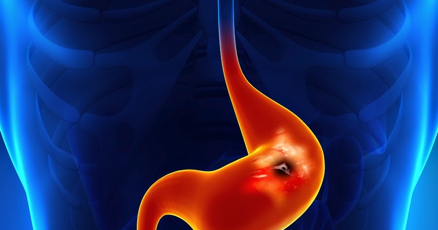 Epidemiology of low back pain in adults