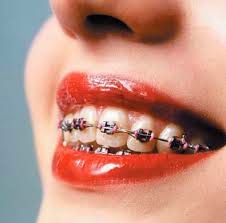 بحث حول تقويم الاسنان | قبل تركيبه تعرف على كل مميزاته واسعاره وانواع تقويم الاسنان %D8%B5%D9%88%D8%B1+%D8%AA%D9%82%D9%88%D9%8A%D9%85+%D8%A7%D9%84%D8%A7%D8%B3%D9%86%D8%A7%D9%86+1.3