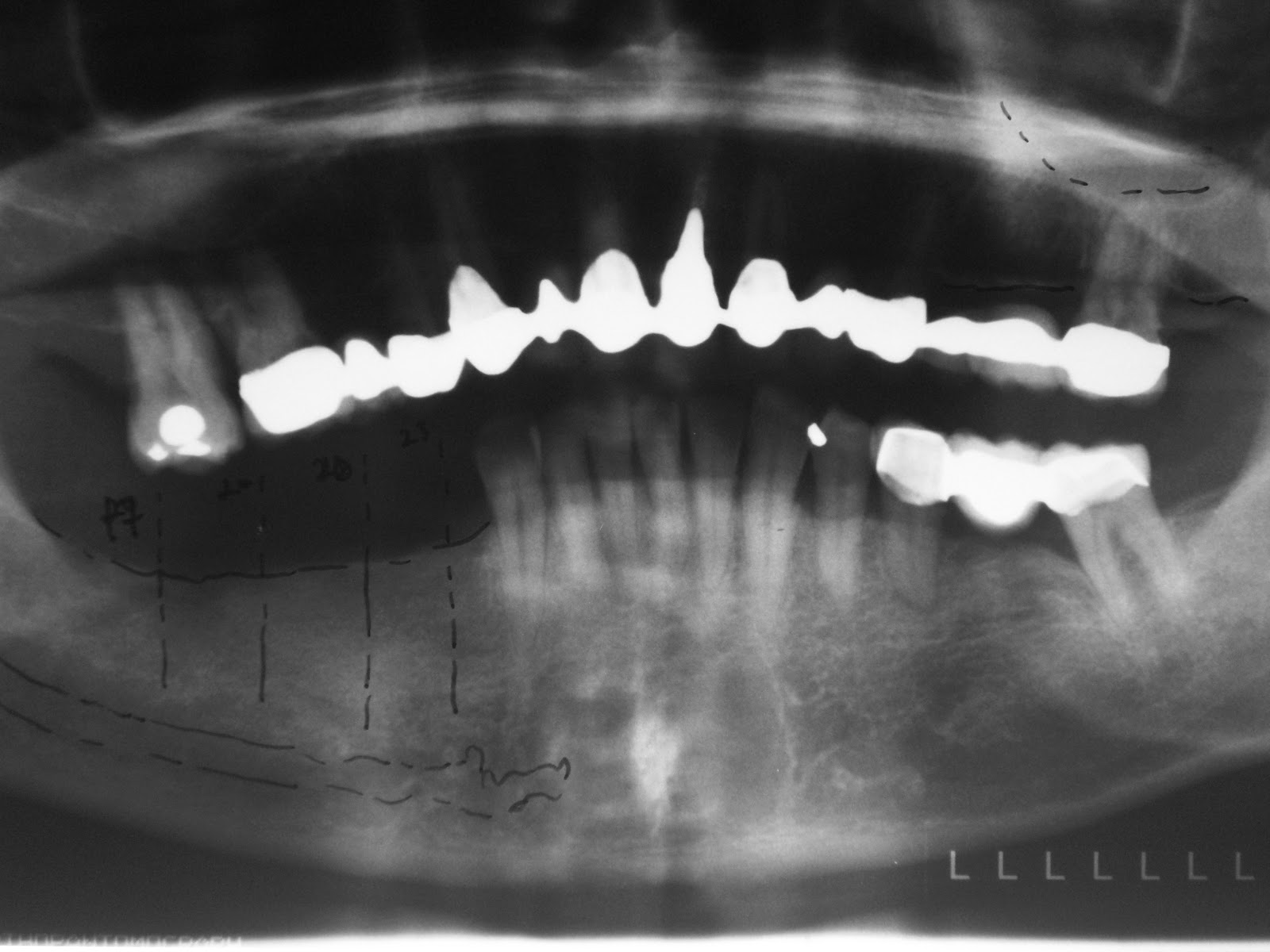 Dental Implantology A KNIFE EDGED RIDGE CASE