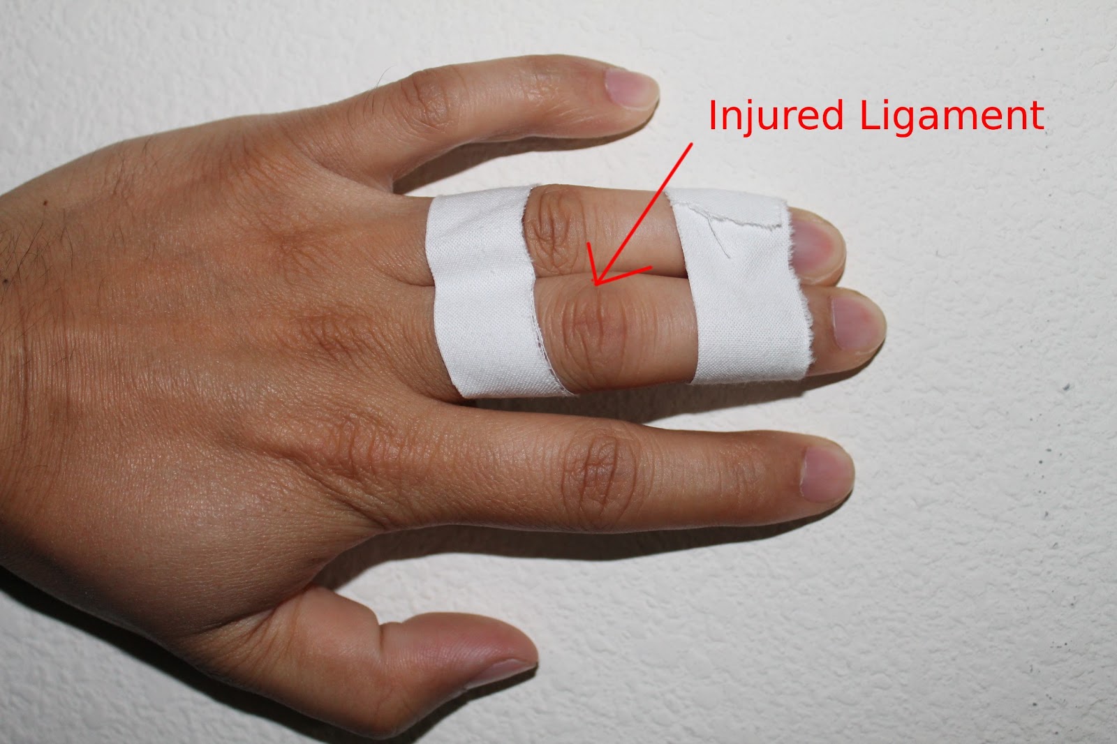 Climbing Finger Injury Treatment at Sarita Kwon blog